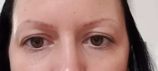 Ugyanaz a szemöldök a lézeres halványítás után, a régi pigment alig látszik.